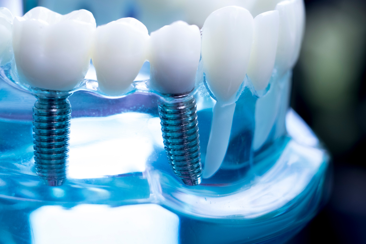 Dentist Dental Teeth Implant